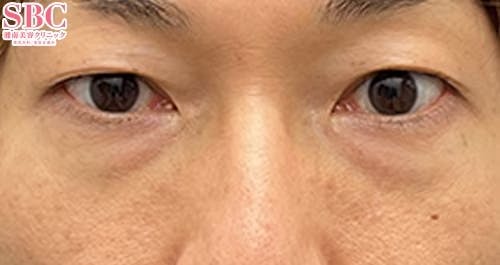 【30代男性・たるみ】目の下の切らないクマ・たるみ（ふくらみ）取り、ナチュラル脂肪注射コンデンスリッチ_before