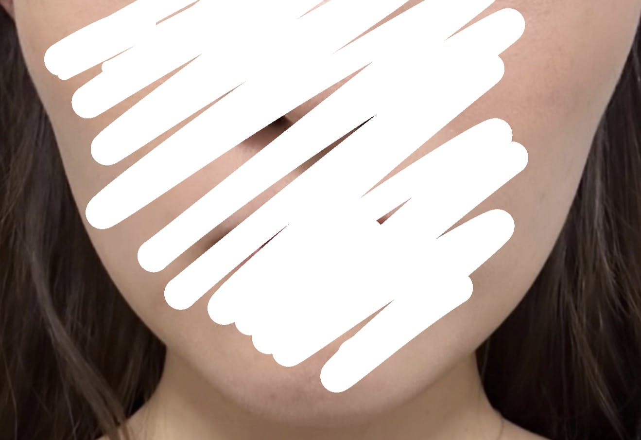 湘南美容クリニック  名古屋院でエラボトックス注射(小顔)を受けたaさんの写真