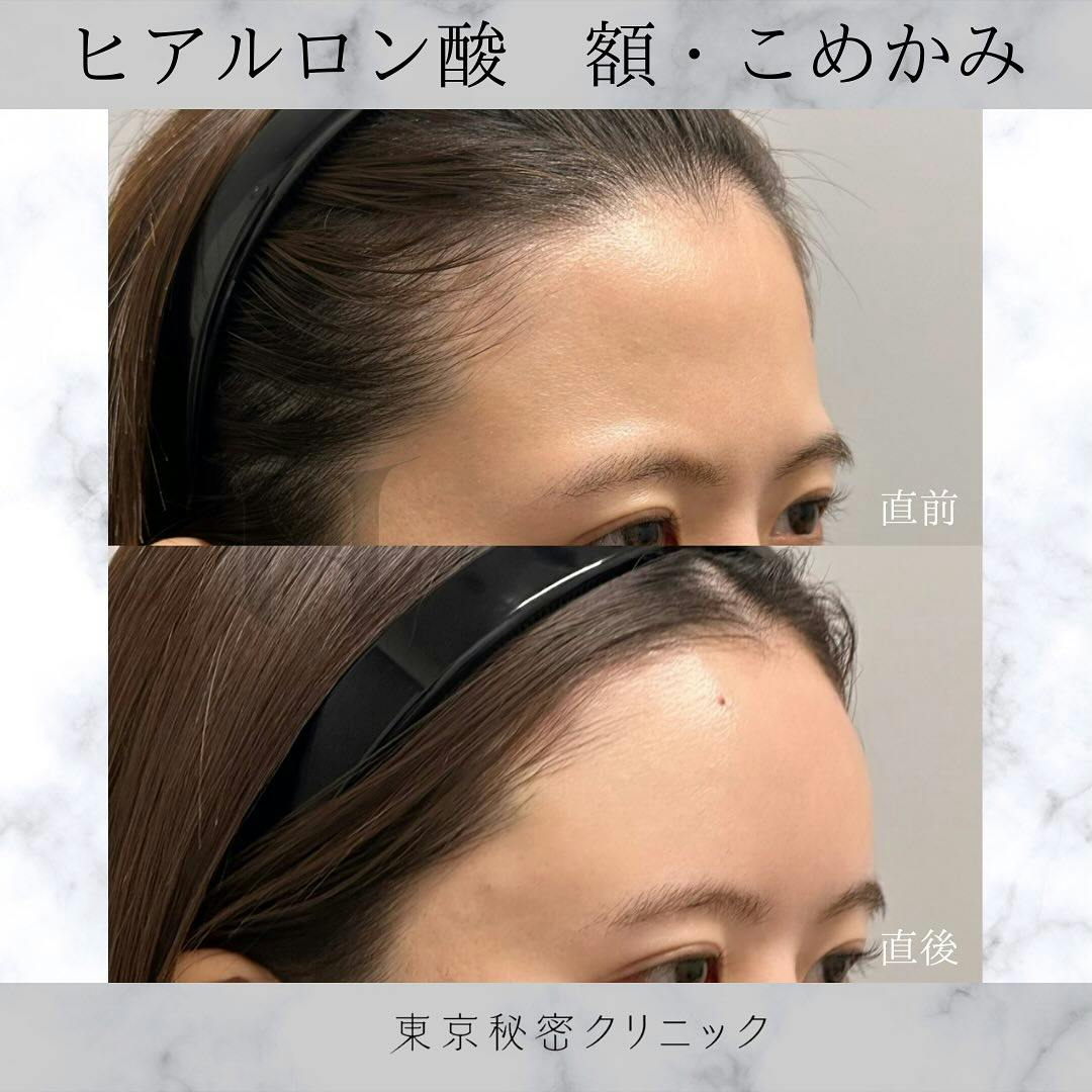 【女性・凹み】ヒアルロン酸（額・こめかみ）_before_aftar