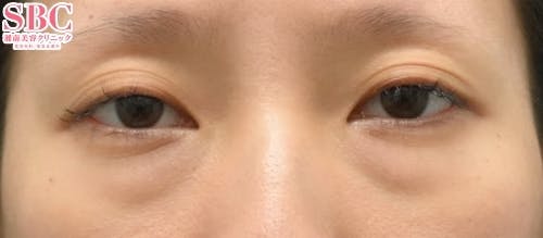 【女性・目元】目の下の切らないクマ・たるみ（ふくらみ）取り、ナチュラル脂肪注射コンデンスリッチ_before