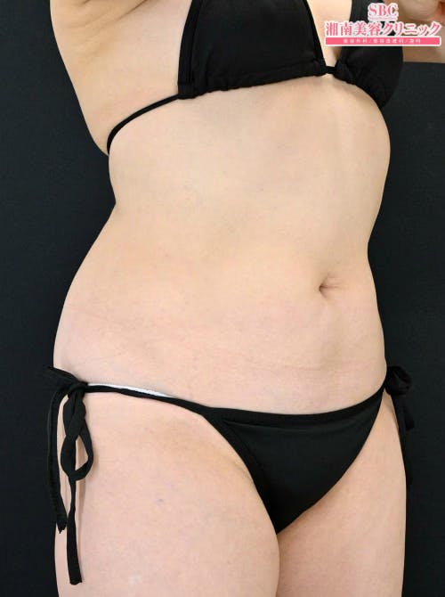 【50代女性・腹部】ダイエット注射 MITI（マイティ）_after