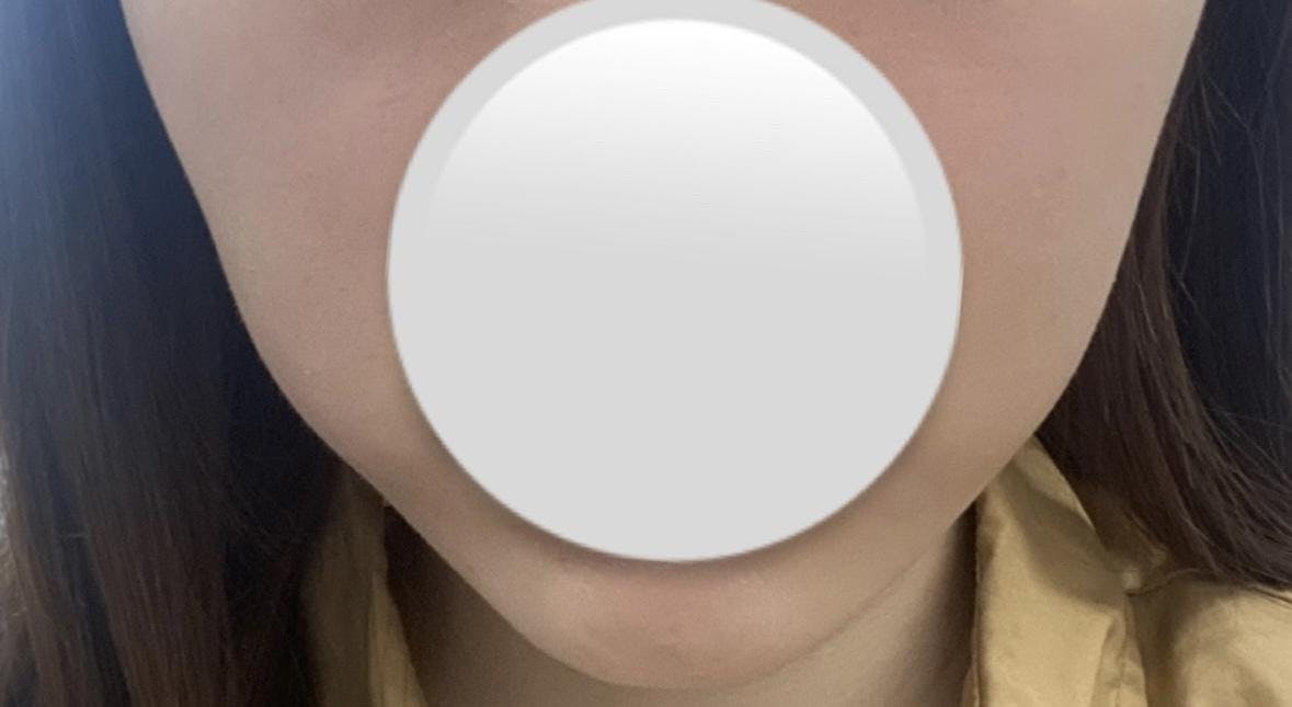 アールビューティークリニック 名古屋院(R Beauty CLINIC)でウルトラセルQハイフを受けたぐーちゃんさんの写真