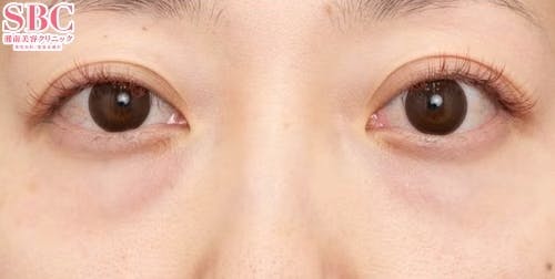 【30代女性・目元】目の下の切らないクマ・たるみ（ふくらみ）取り、ナチュラル脂肪注射コンデンスリッチ、ナチュラル脂肪注射ナノリッチ_before