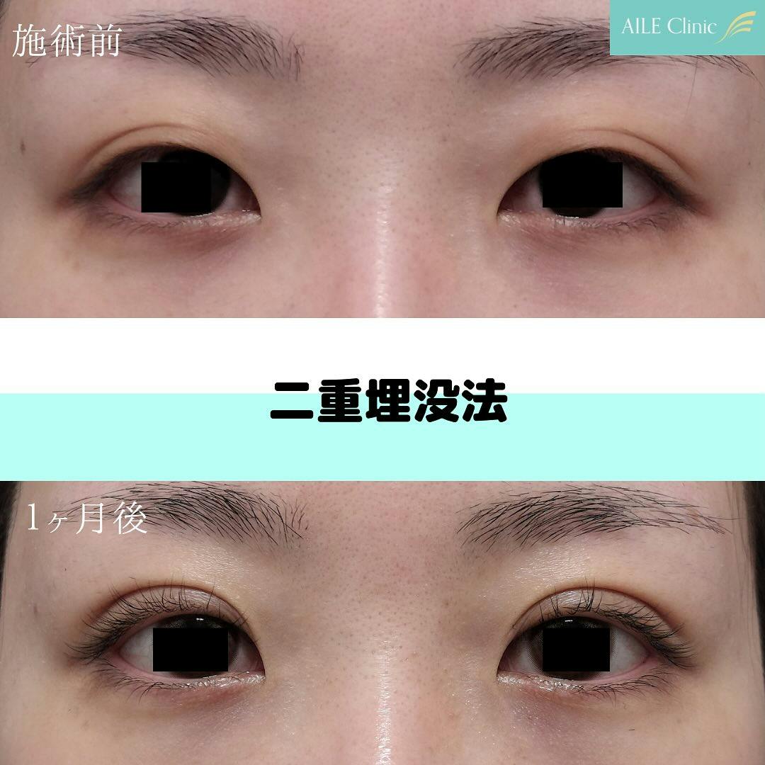 【女性・目元】二重埋没法_before_aftar