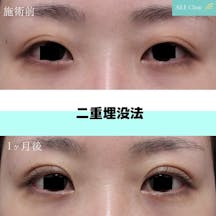 【女性・目元】二重埋没法_before_aftar