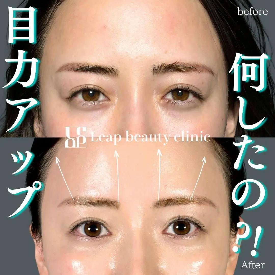 【20代女性・目元】フォックスアイリフト_before_aftar