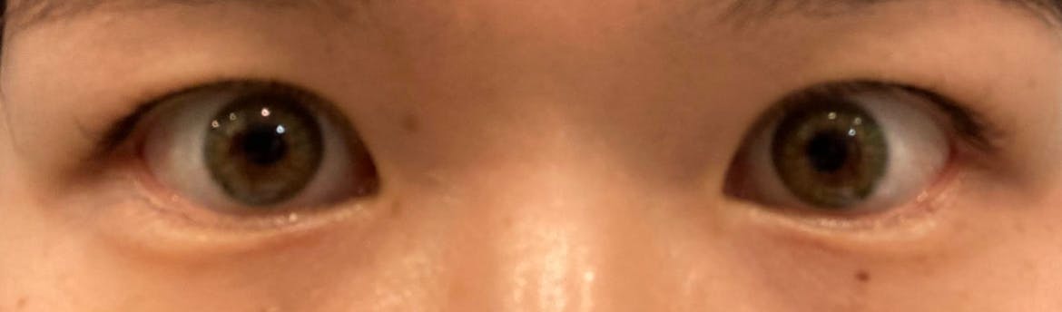 湘南美容クリニック Regno銀座院で二重整形・二重埋没・奥二重整形・末広二重整形・平行二重整形・ミックス型二重整形・目元整形を受けたるんさんの写真