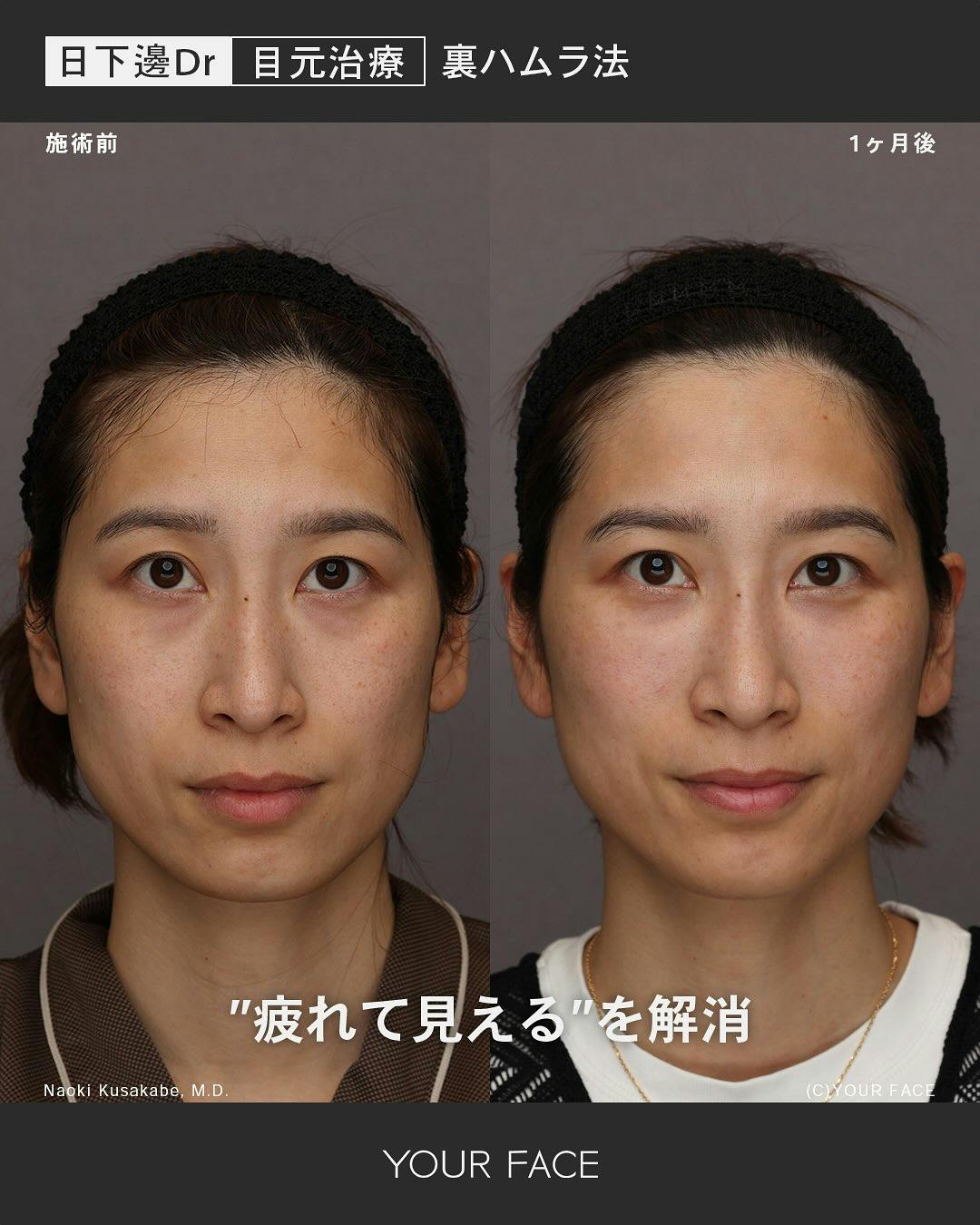 【女性・クマ】裏ハムラ法 中顔面リフト_before_aftar