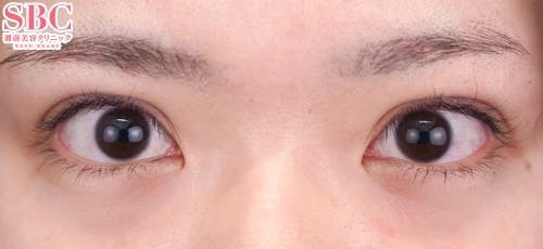 【20代女性・目元】ハイブリッド式二重術_0day