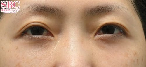 【女性・目元】目の下の切らないクマ・たるみ（ふくらみ）取り、ナチュラル脂肪注射コンデンスリッチ_after