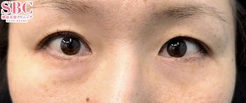 【女性・目元】目の下の切らないクマ・たるみ（ふくらみ）取り_before