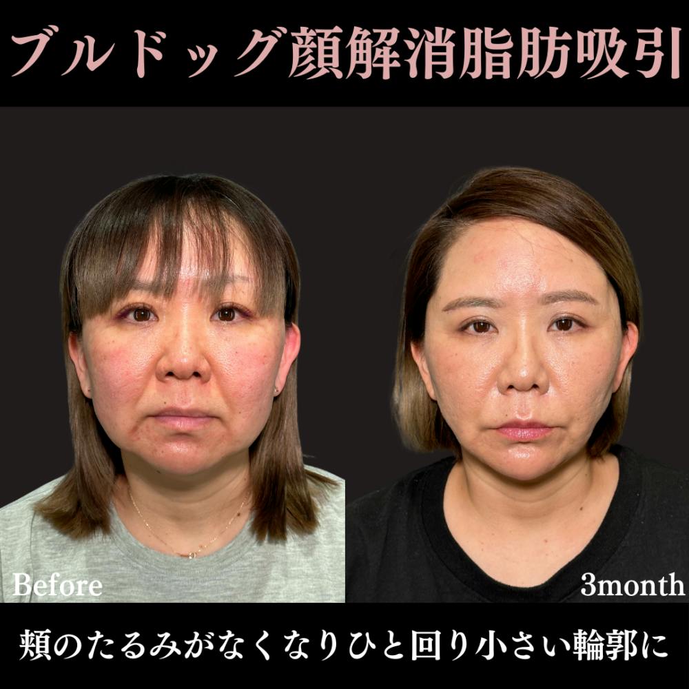 【40代女性・顔】脂肪吸引プレミアム（頬・顎下）＋グランリフト＋ウルトラソフト_before_aftar