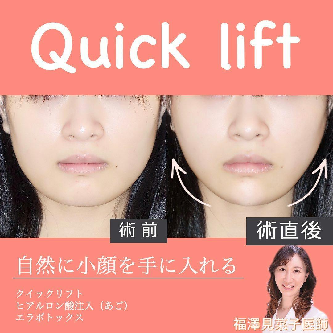 【女性・小顔】クイックリフト、エラボトックス、ヒアルロン酸（顎）_before_aftar
