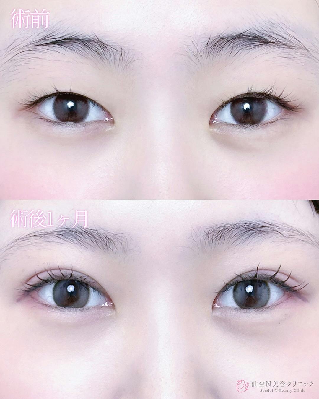 【女性・目元】二重埋没法（シークレットトリプル）_before_aftar