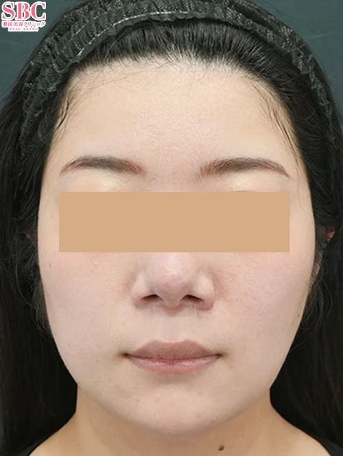 【女性・輪郭】小顔用脂肪吸引注射_after