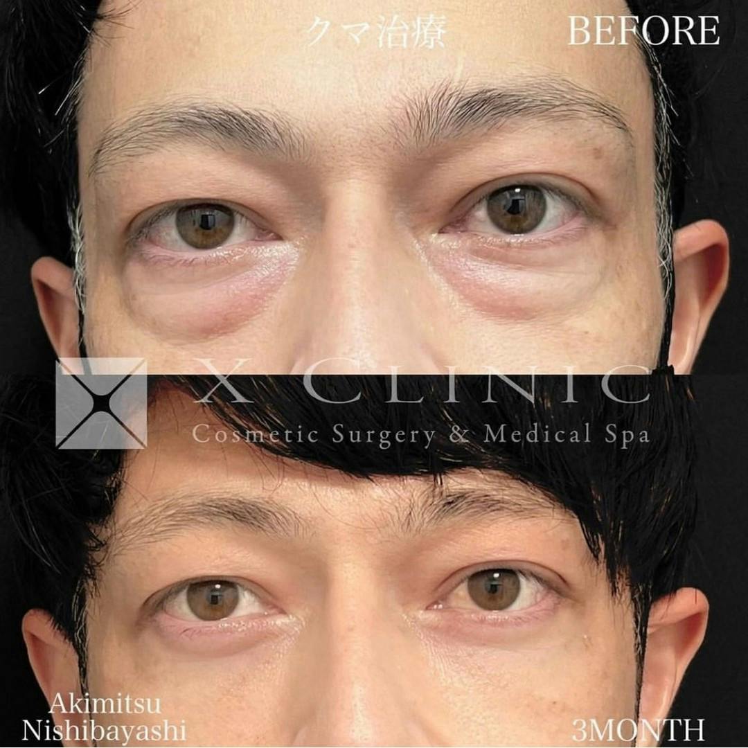 【男性・目元】クマ取りフルコース_before_aftar