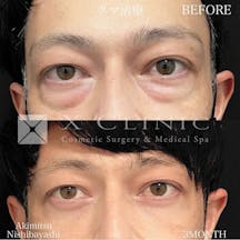 【男性・目元】クマ取りフルコース_before_aftar