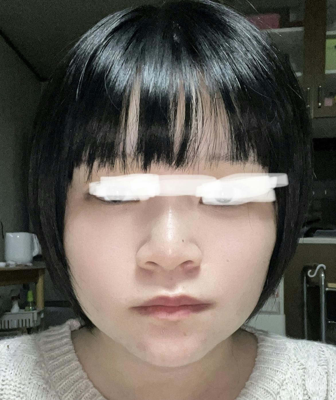 ルラ美容クリニック 渋谷本院でインモードリフティングを受けたゆかさんの写真
