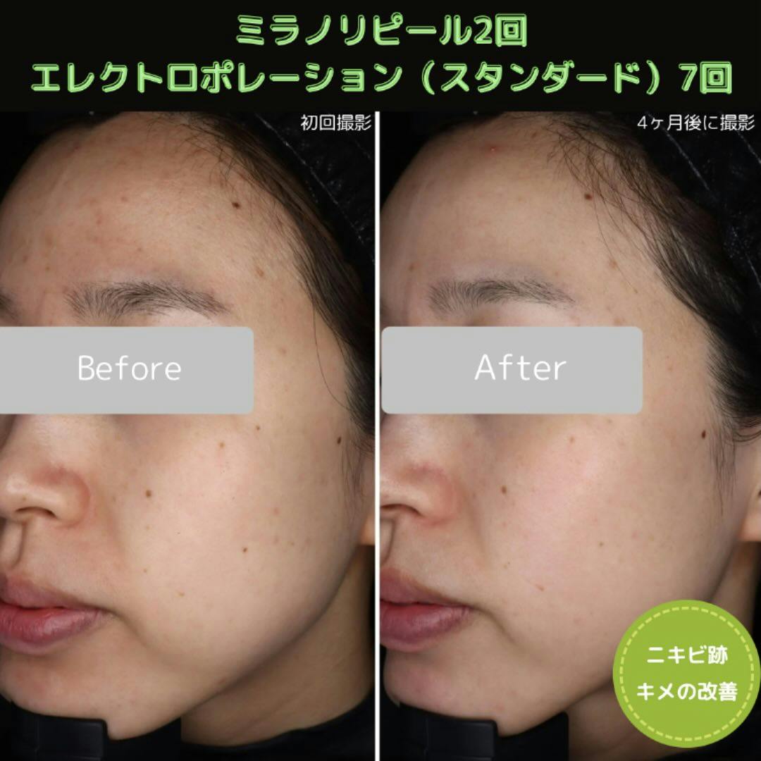 ミラノリピールができる美容クリニックの症例写真・ビフォーアフター