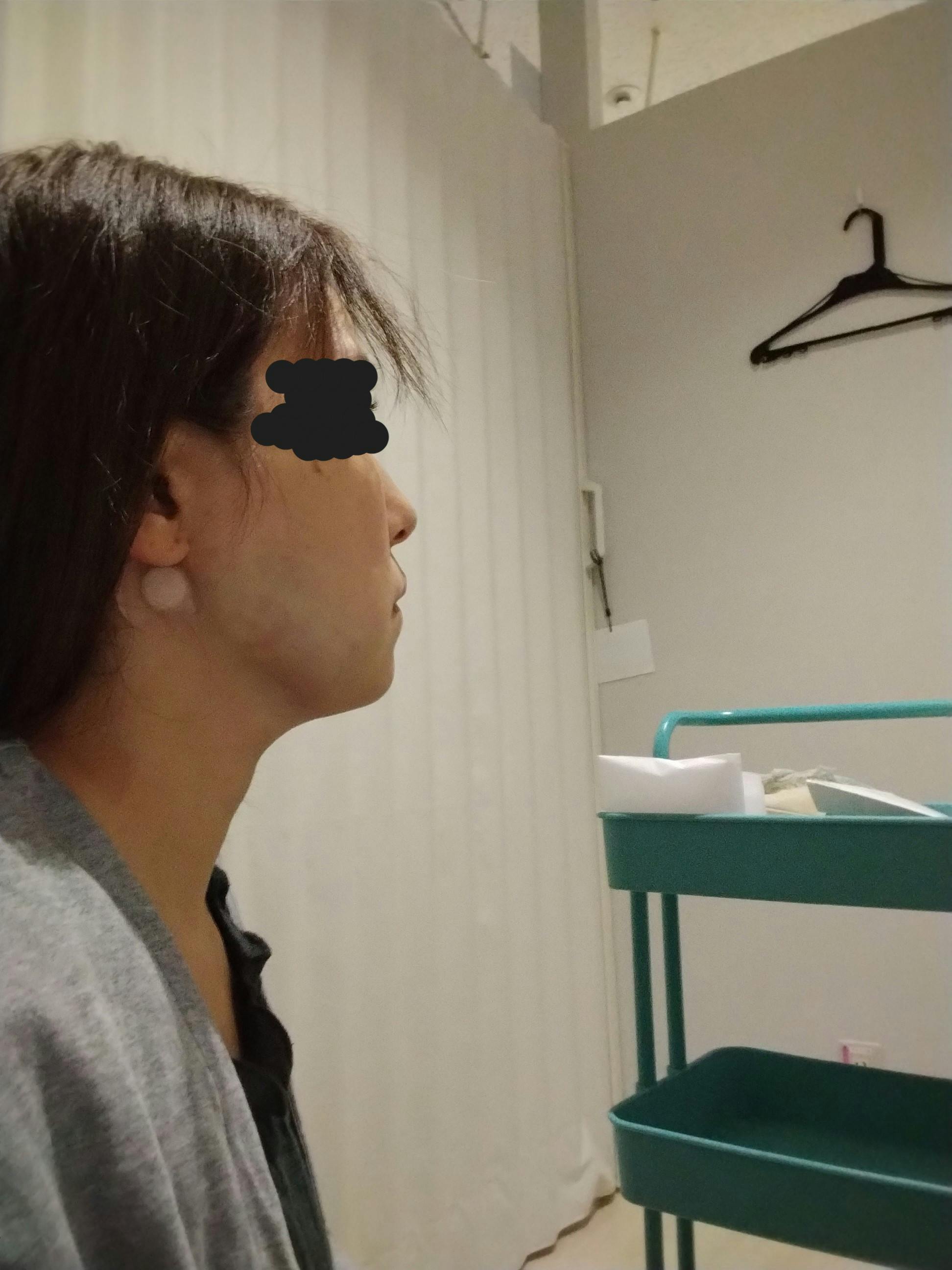 湘南美容クリニック 町田院でを受けたジャスミンさんの写真