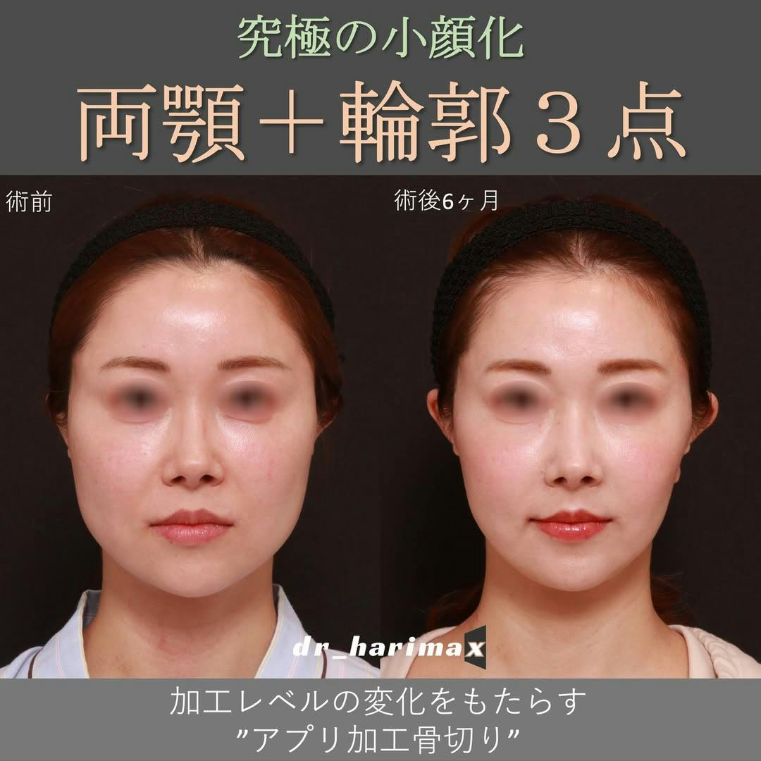 Ginza78Clinic(銀座セブンエイトクリニック)】78式美肌小顔糸リフトの