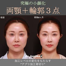 【女性・顔】上下顎骨切り術・輪郭3点_before_aftar
