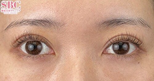 【20代女性・目元】線留めクロス二重術_after