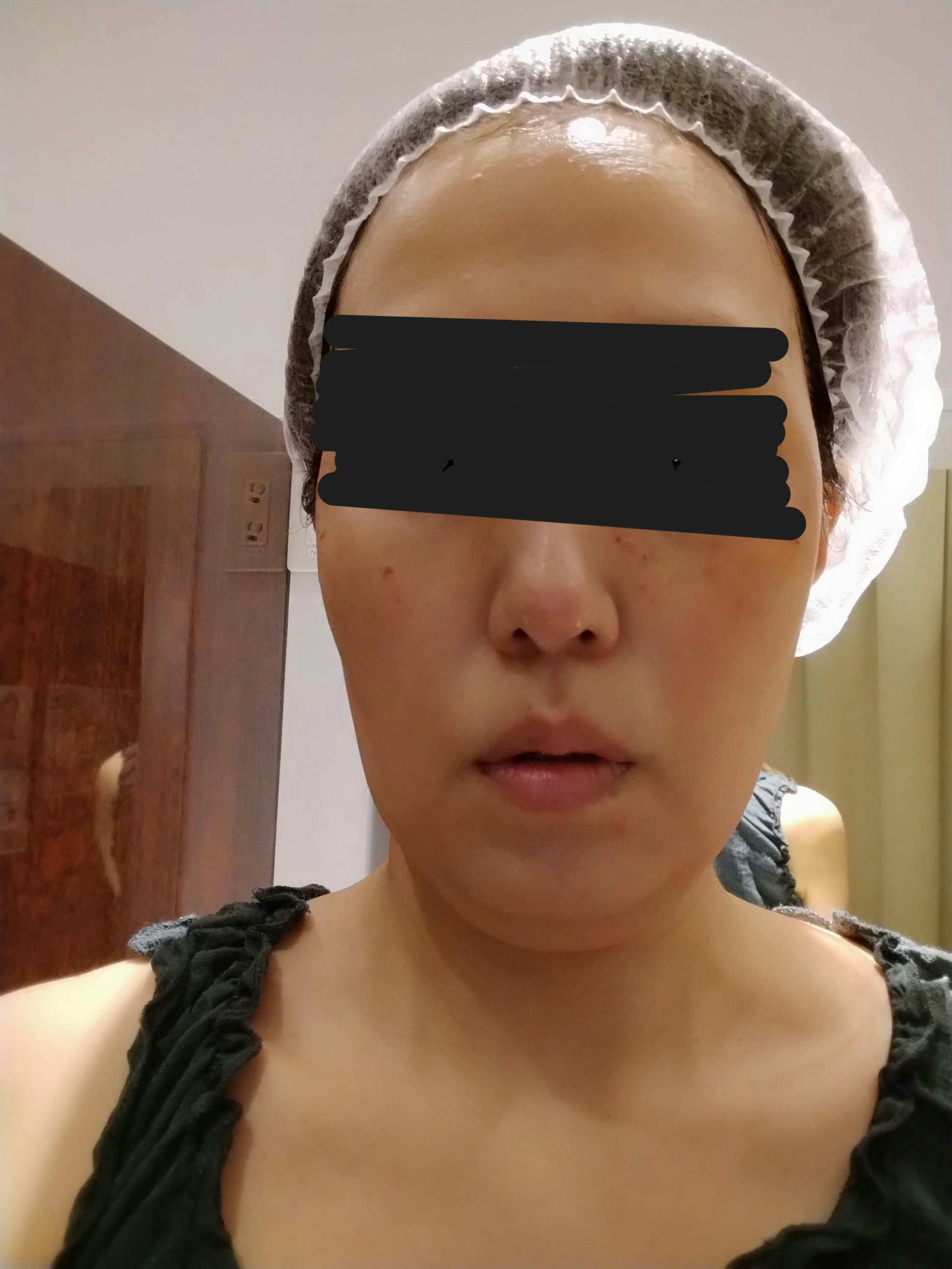湘南美容クリニック 町田院でを受けたジャスミンさんの写真