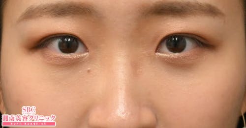 【20代女性・目元】目の下の切らないクマ・たるみ（ふくらみ）取り ナチュラル脂肪注射コンデンスリッチ ナチュラル脂肪注射ナノリッチ_after