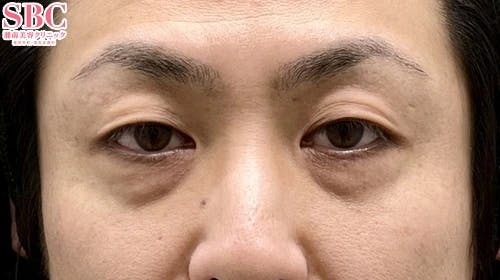 【男性・目元】ナチュラル脂肪注射コンデンスリッチ ナチュラル脂肪注射ナノリッチ 目の下の切らないクマ・たるみ（ふくらみ）取り_before