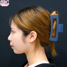 【女性・小顔】小顔用脂肪吸引注射_after