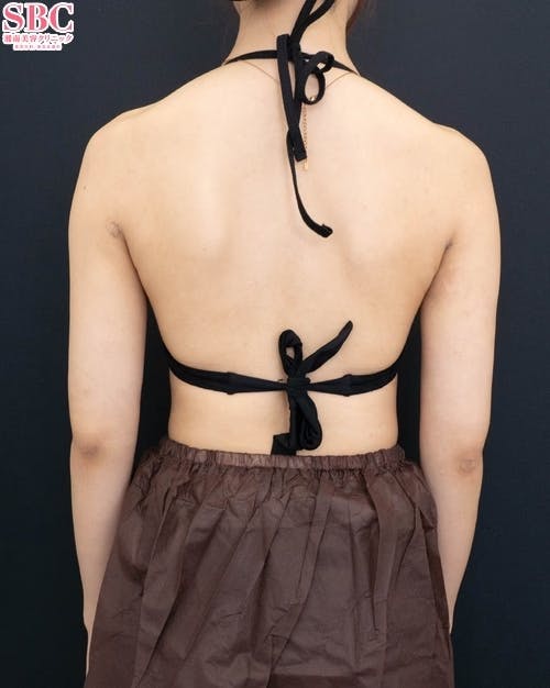 【20代女性・二の腕】Aquicell（アキーセル）脂肪吸引、根こそぎVASER脂肪吸引_after