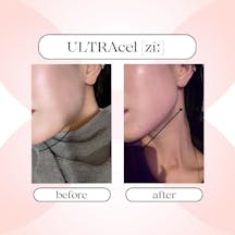 【女性・輪郭】ハイフウルトラセルZi_before_aftar