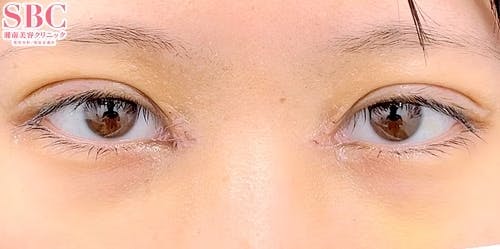 【女性・目元】クイックコスメティーク・ダブルNeo、目頭切開プレミアム、自然癒着セット（上眼瞼脱脂）_1week