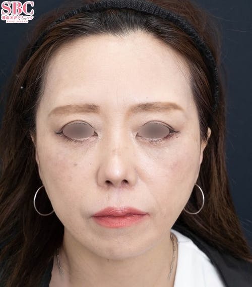 【40代女性・顔】アイバックリムーブ法、VASER併用アキーセル脂肪吸引、ナチュラル脂肪注射コンデンスリッチ、ナチュラル脂肪注射ナノリッチ、SBCプリマリフト、シークレットリフト、VOVリフト_after