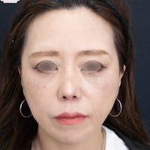 【40代女性・顔】アイバックリムーブ法、VASER併用アキーセル脂肪吸引、ナチュラル脂肪注射コンデンスリッチ、ナチュラル脂肪注射ナノリッチ、SBCプリマリフト、シークレットリフト、VOVリフト_after