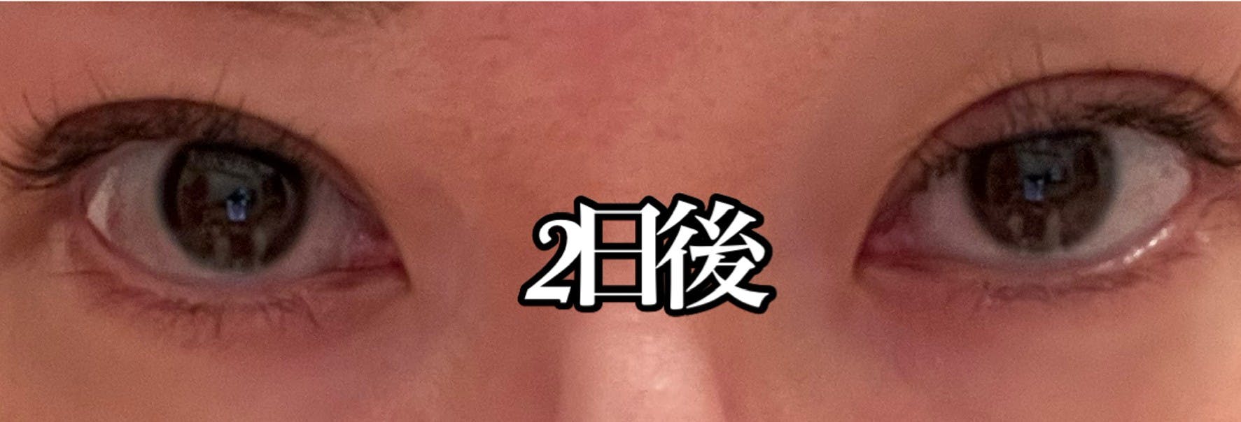 湘南美容クリニック 池袋東口院で二重整形・二重埋没・奥二重整形・末広二重整形・平行二重整形・ミックス型二重整形・目元整形を受けたにゃんにゃんこさんの写真