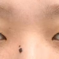 【33歳女性・目元】グランドループ法_before