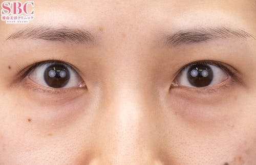 【20代女性・目元】目の下の切らないクマ・たるみ（ふくらみ）取り、ナチュラル脂肪注射コンデンスリッチ、ナチュラル脂肪注射ナノリッチ_before