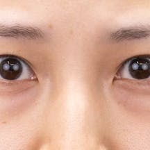 【20代女性・目元】目の下の切らないクマ・たるみ(ふくらみ)取り、ナチュラル脂肪注射コンデンスリッチ、ナチュラル脂肪注射ナノリッチ_before
