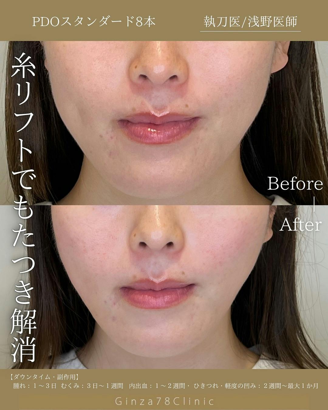 【女性・小顔】糸リフト(PDOスタンダード)_before_aftar