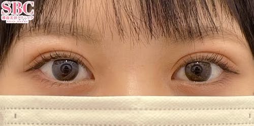 【女性・目元】二重_aftar
