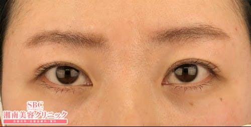 【女性・目元】眼瞼下垂＋二重、目の下の切らないクマ・たるみ（ふくらみ）取り_after
