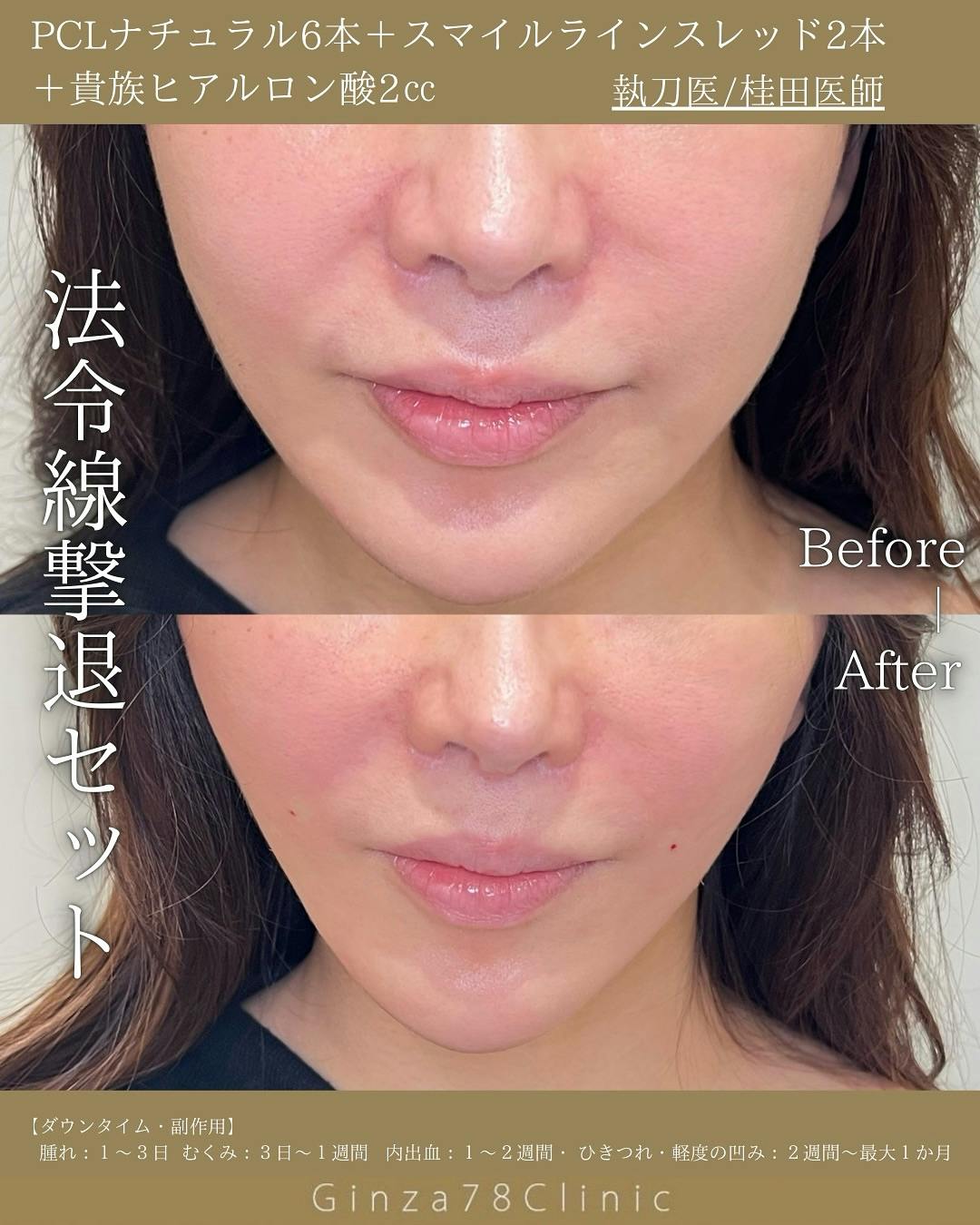 【女性・ほうれい線】糸リフト_before_aftar