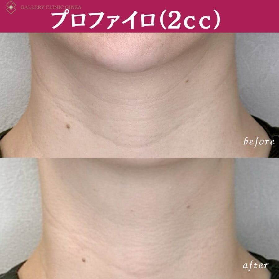 【女性・シワ】プロファイロ_before_aftar