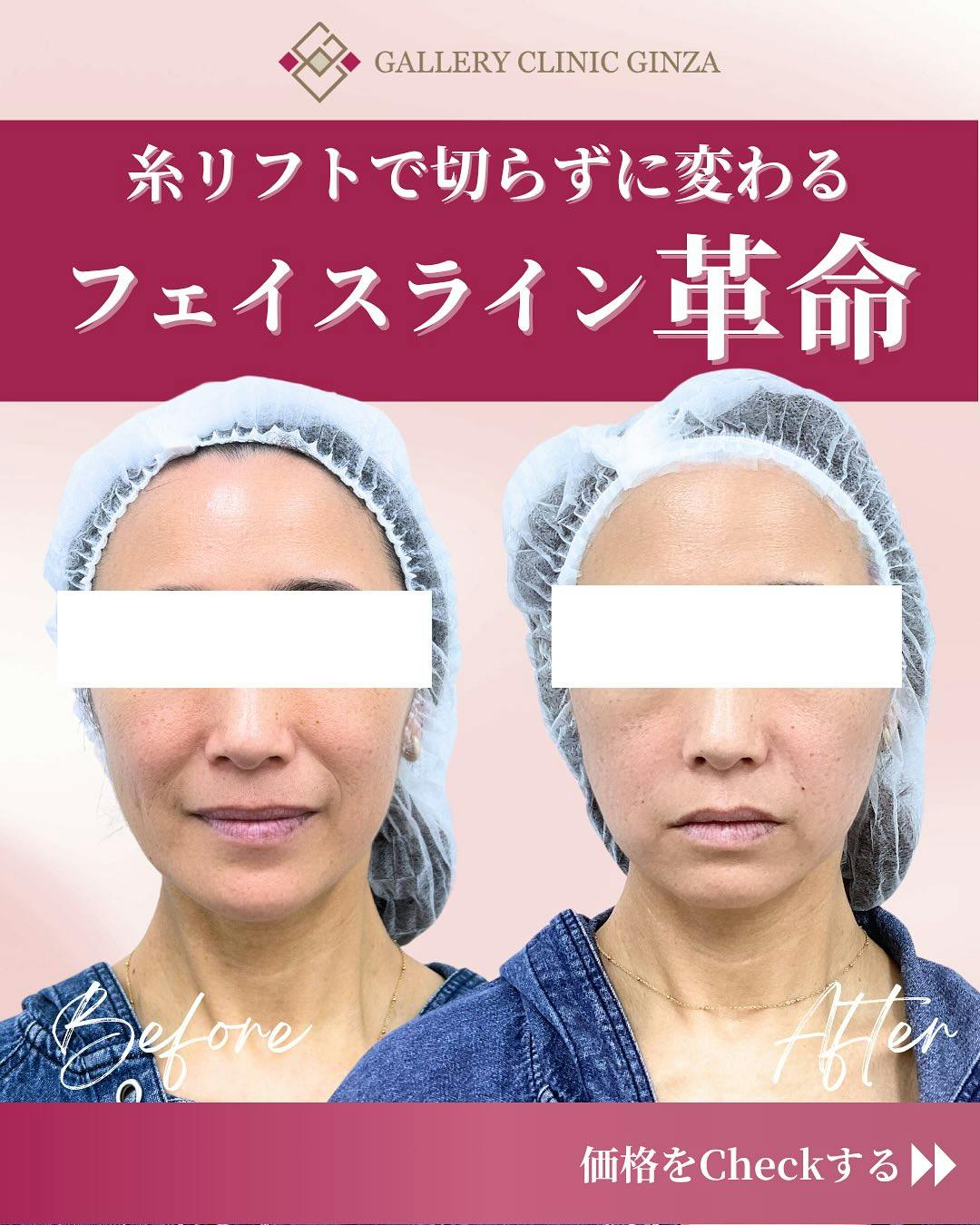 【女性・たるみ】アルテミスリフト_before_aftar