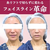 【女性・たるみ】アルテミスリフト_before_aftar