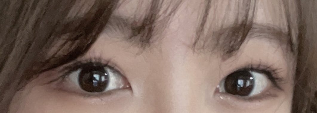 湘南美容クリニック 岡山院で二重整形・二重埋没・奥二重整形・末広二重整形・平行二重整形・ミックス型二重整形・目元整形を受けたちーさんの写真