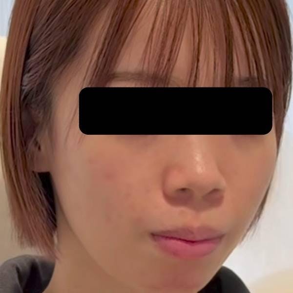 みずほクリニックで鼻整形：鼻プロテーゼ挿入（鼻を高くする）を受けたポートさんの写真