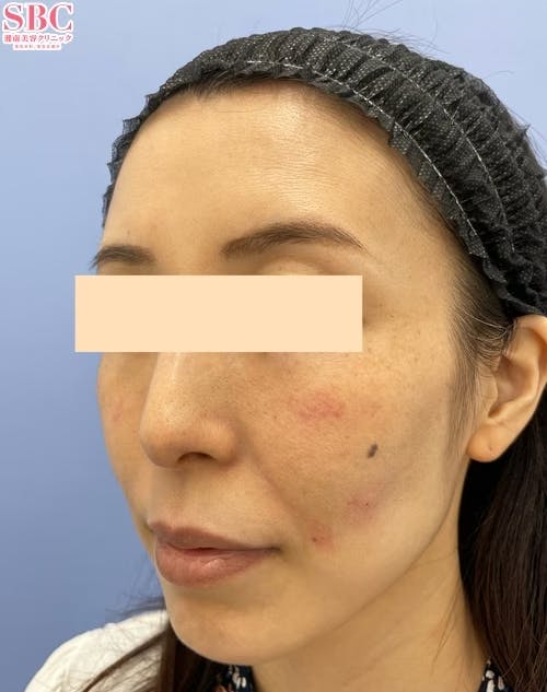 【女性・頬】ヒアルロン酸ジュビダームビスタ バイクロスシリーズ_before